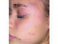 Vomero, selvaggia aggressione fuori scuola: 13enne ferita da baby bulle per gelosia