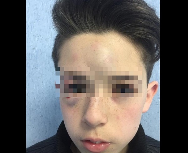 Aggredito dai bulli a Mugnano, genitori postano foto col volto tumefatto: “Fermate i violenti”