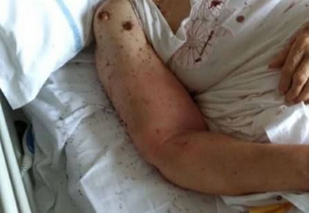 Napoli, centinaia di formiche nel letto con la paziente: allarme all’ospedale San Paolo