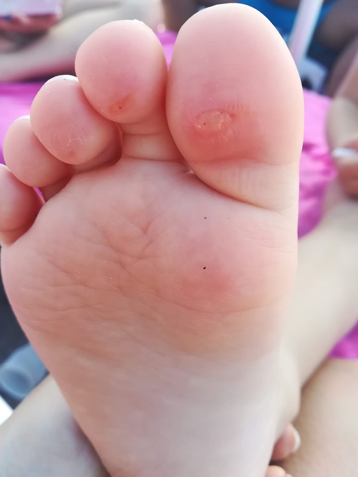 Licola: Bolle e lesioni ai piedi di bimbi dopo bagno in piscina, Asl chiude Pareo Park